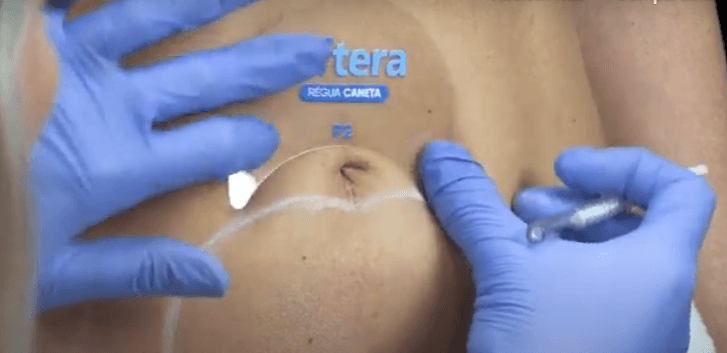 Marcação com outras réguas