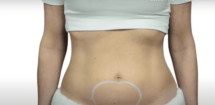 Abdômen - Pinch Test_Liftera A