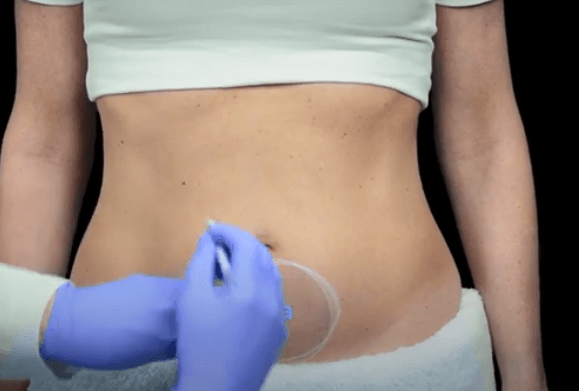 Marcação do Abdômen