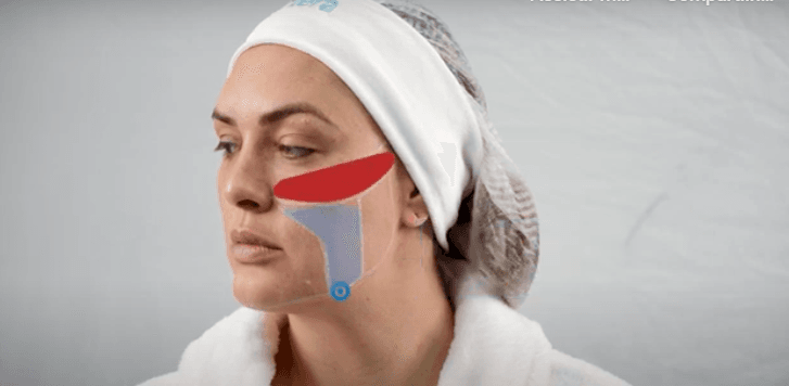 Heavy Face com redução de gordura - MARCAÇÃO