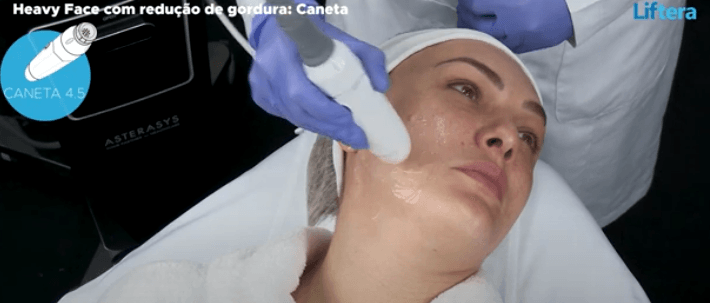 Heavy Face com redução de gordura - PROTOCOLO